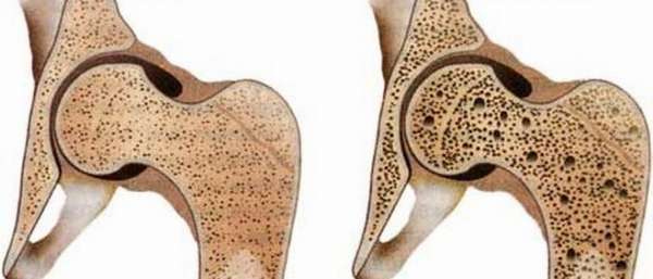 Как укрепить кости при остеопорозе?